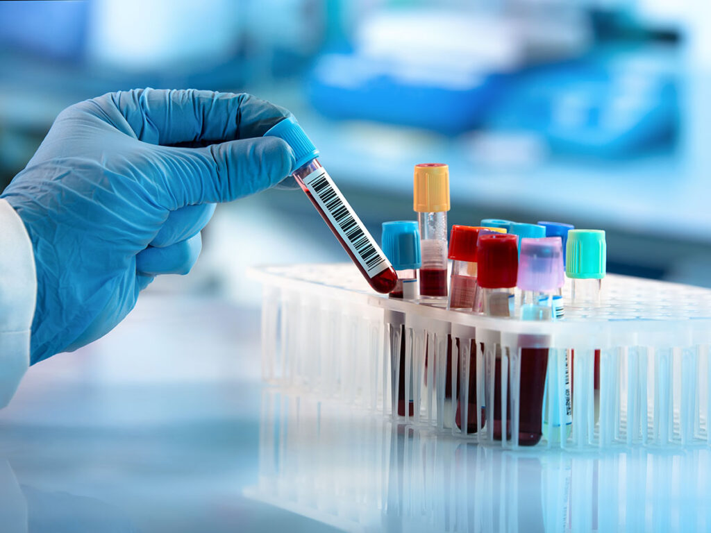 doctor hand taking a blood sample tube from a rack with machines of analysis in the lab background / Technician holding blood tube test in the research laboratory